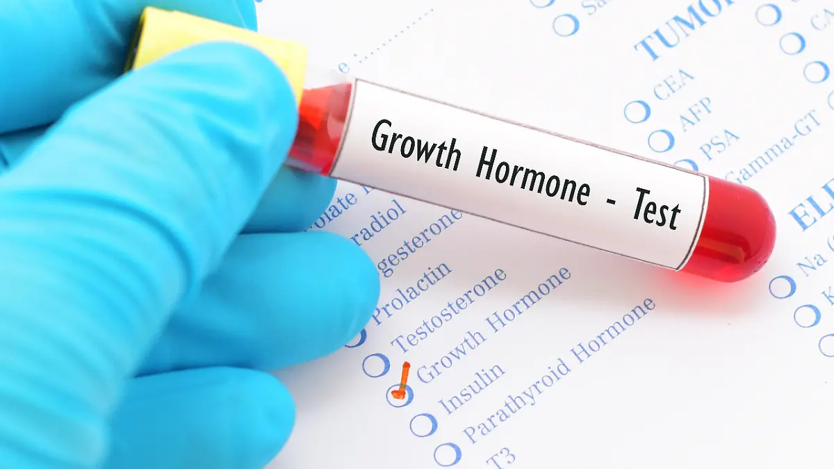 Gesundheitslexikon: Die Akromegalie ist eine Erkrankung, bei der die Hirnanhangsdrüse (Hypophyse) große Mengen an Wachstumshormonen produziert und freisetzt.