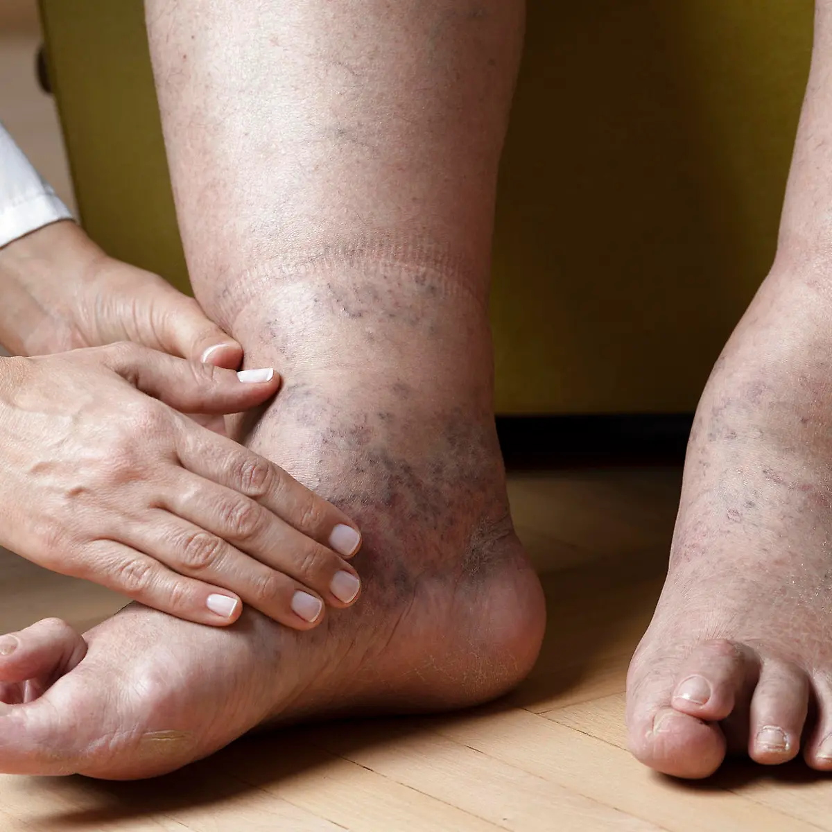 Wassereinlagerungen (Ödeme) Logo von Wassereinlagerungen (Ödeme)