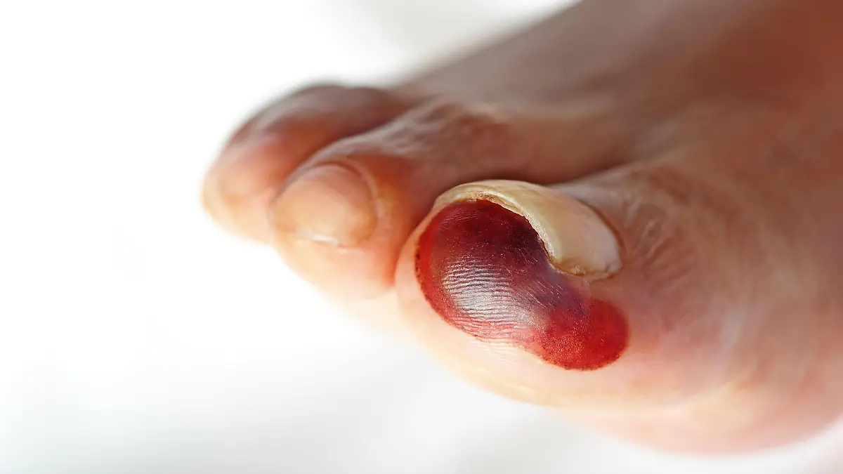 Gesundheitslexikon: Gangrän