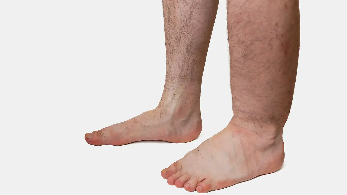Elephantiasis ist die schwerste Ausprägung des Lymphödems