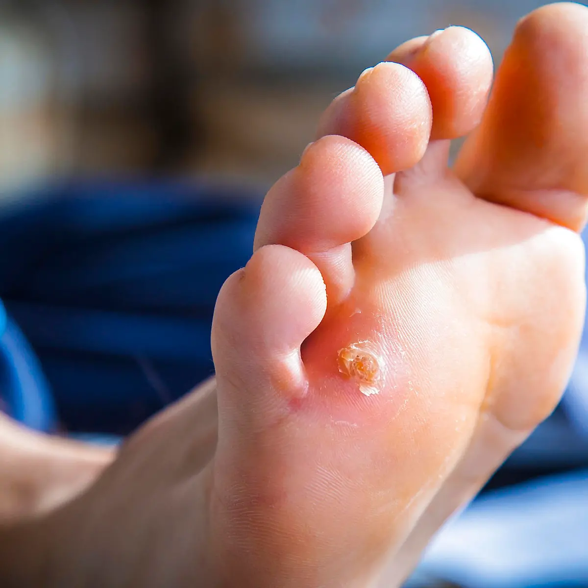 Hühnerauge (Clavus) Logo von Hühnerauge (Clavus)