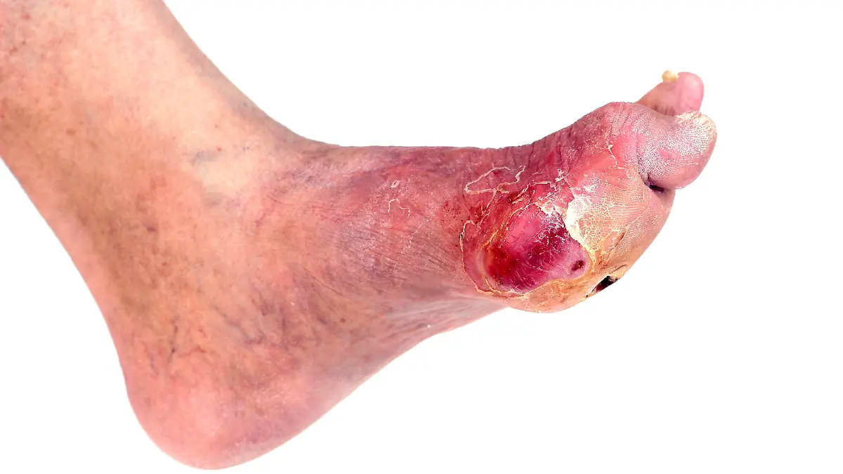 Der diabetische Fuß ist eine durch schlecht heilende chronische Wunden des Fußes gekennzeichnete Komplikation des Diabetes mellitus