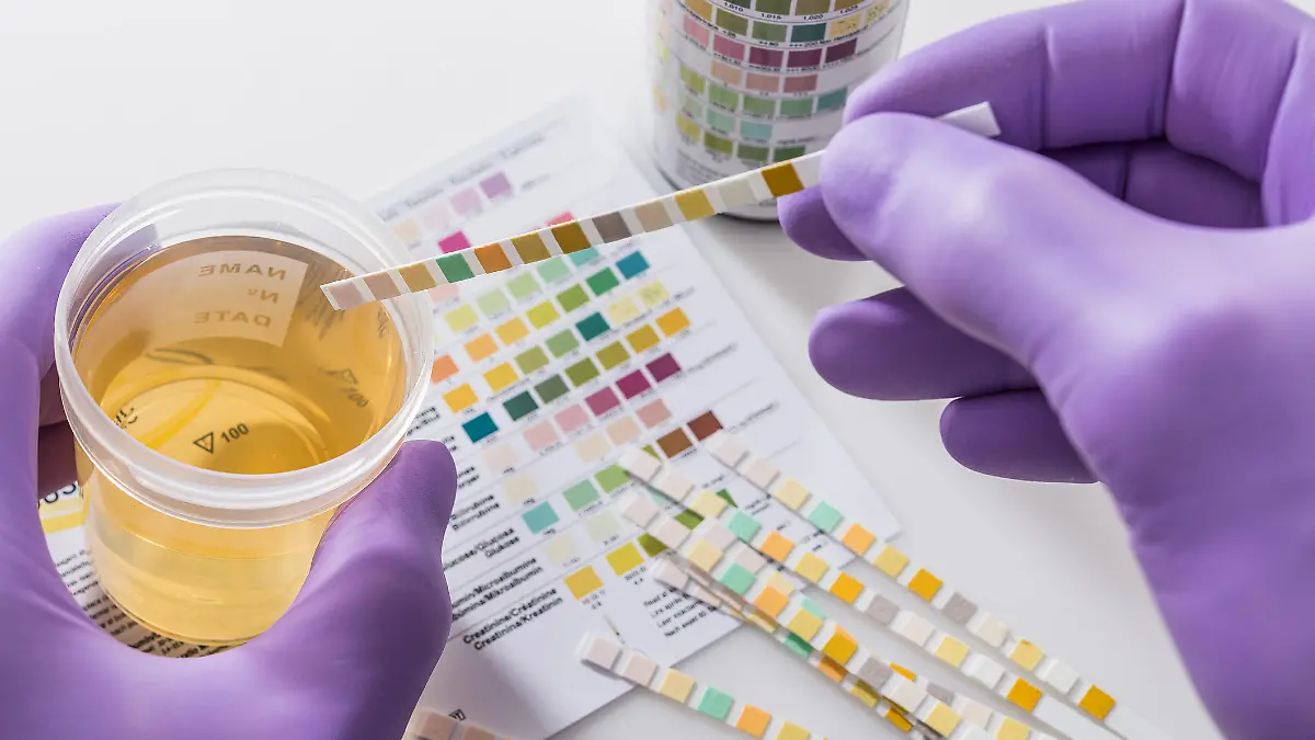 Gesundheitslexikon: Hämaturie