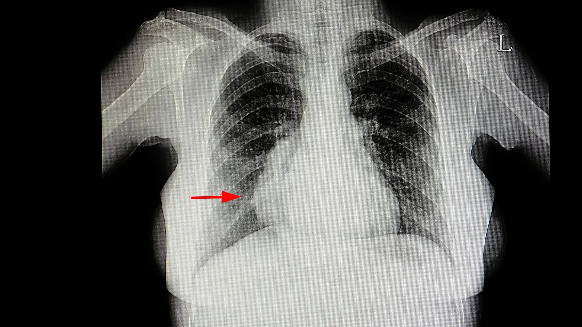 Gesundheitslexikon: Mediastinum