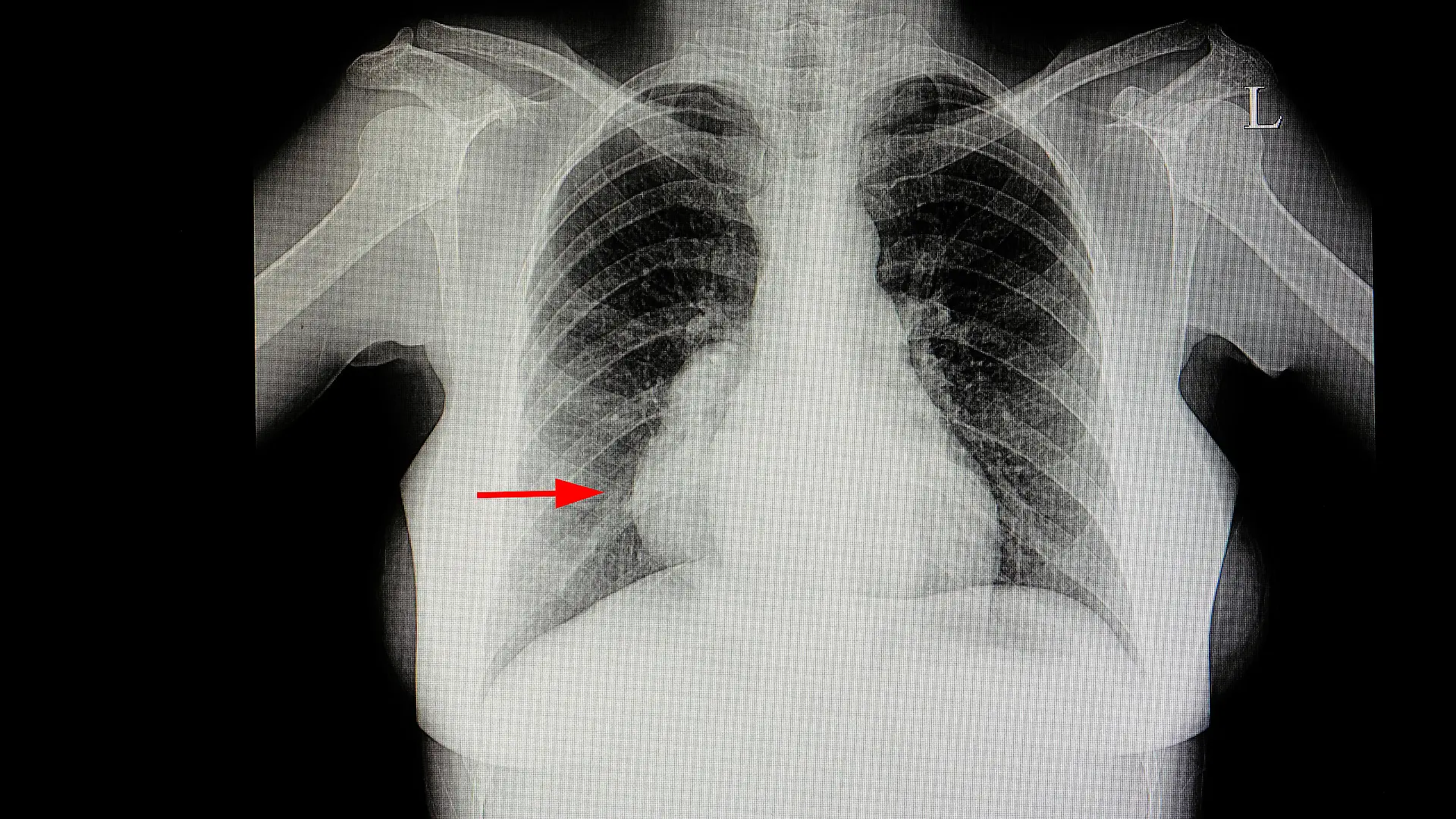 Gesundheitslexikon: Mediastinum