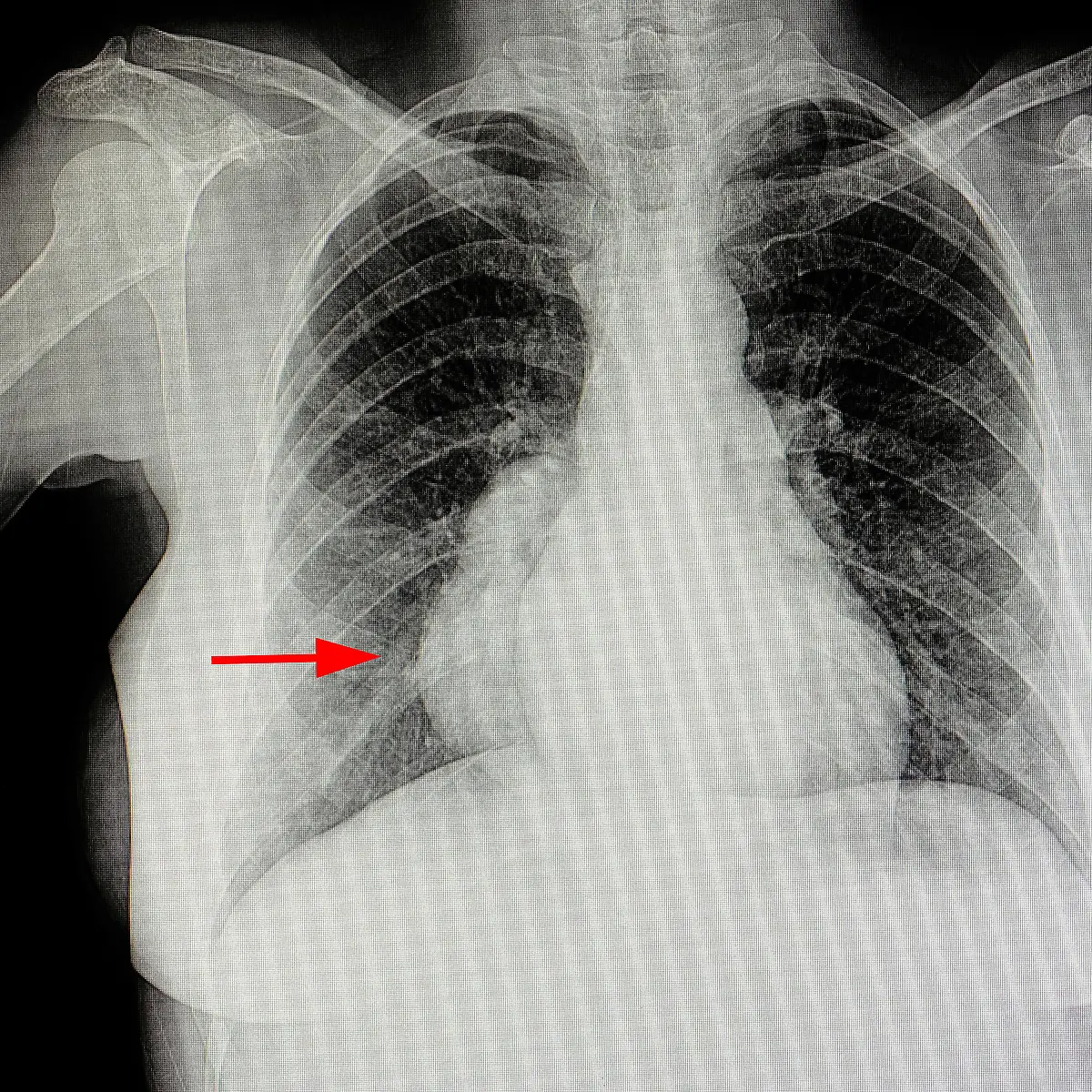 Mediastinum (Mittelfellraum) Logo von Mediastinum (Mittelfellraum)