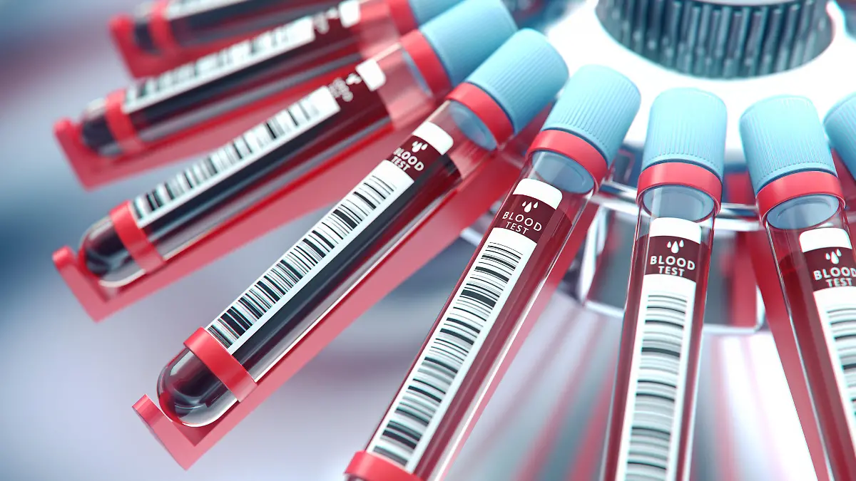 Gesundheitslexikon: Die Blutsenkung kann auf Entzündungen und andere Krankheiten hinweisen