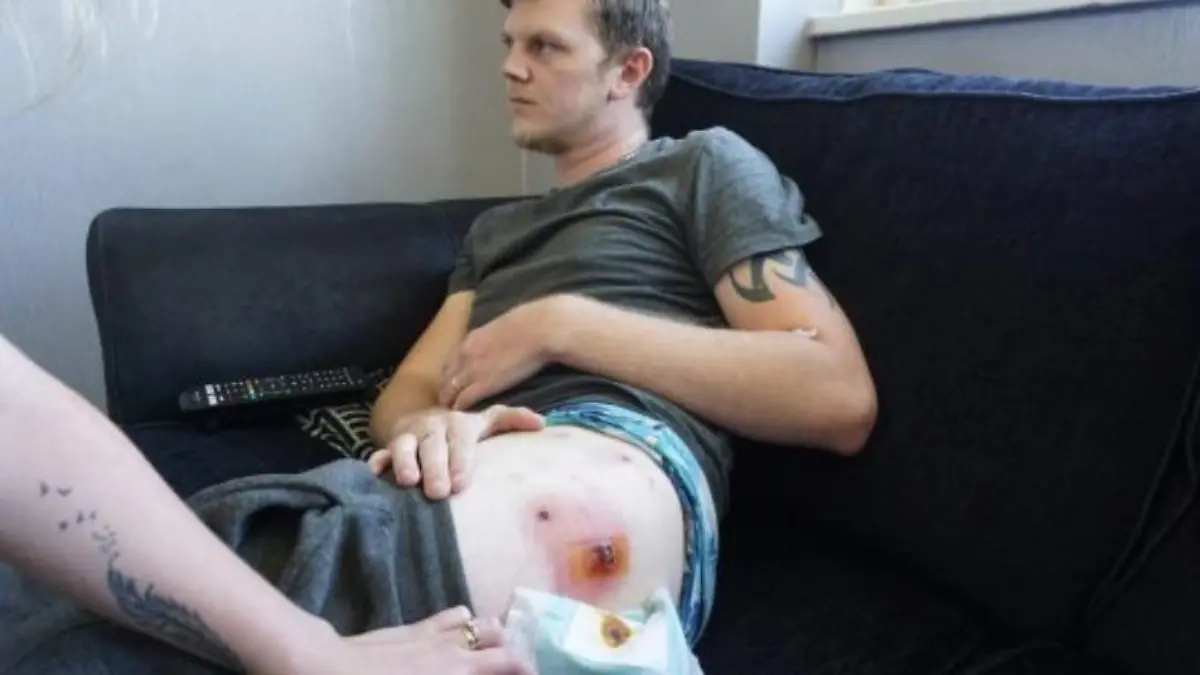 Lewis Pearce wurde von Spinnen gebissen