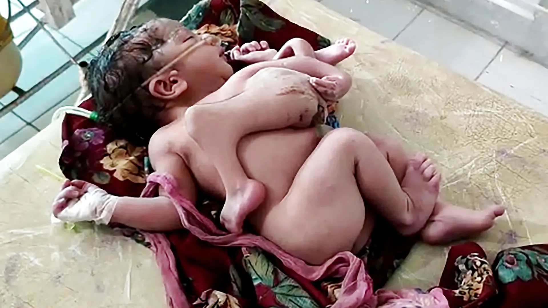 Baby mit vier Beinen und drei Armen